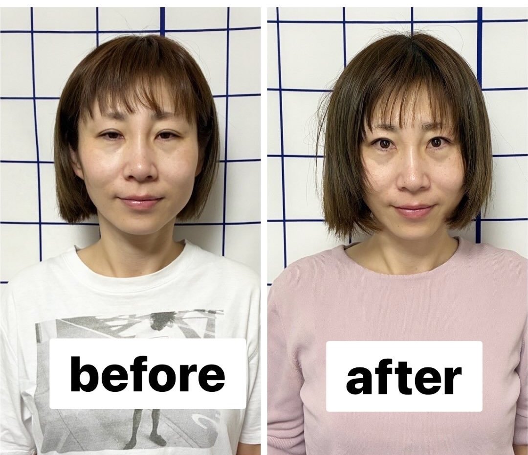小顔矯正の施術前と施術後。顔のむくみが取れてフェイスラインが引き締まっている