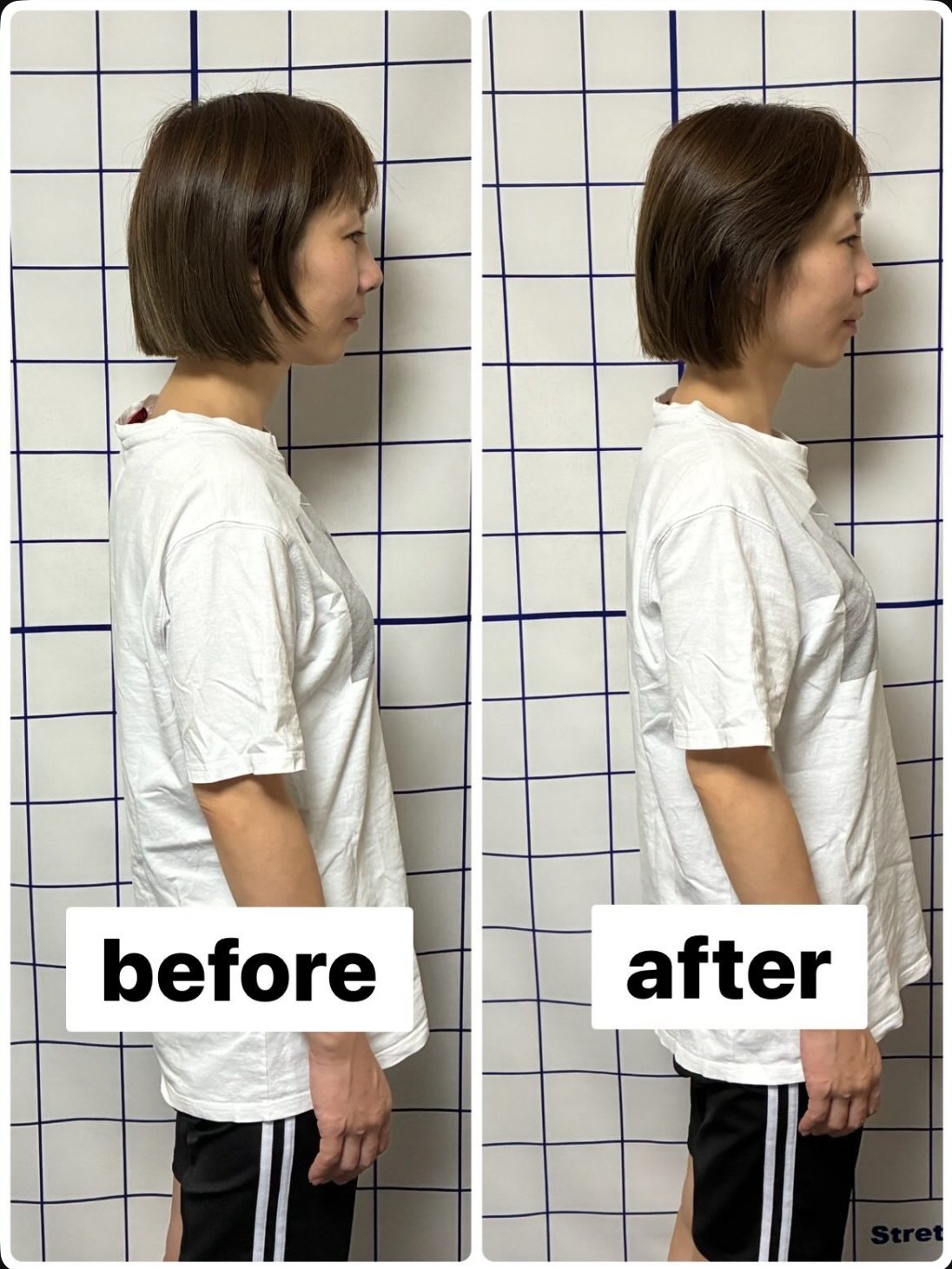 姿勢改善の施術前と施術後。あごが引けて首筋が伸び、肩の位置が後ろに戻っている